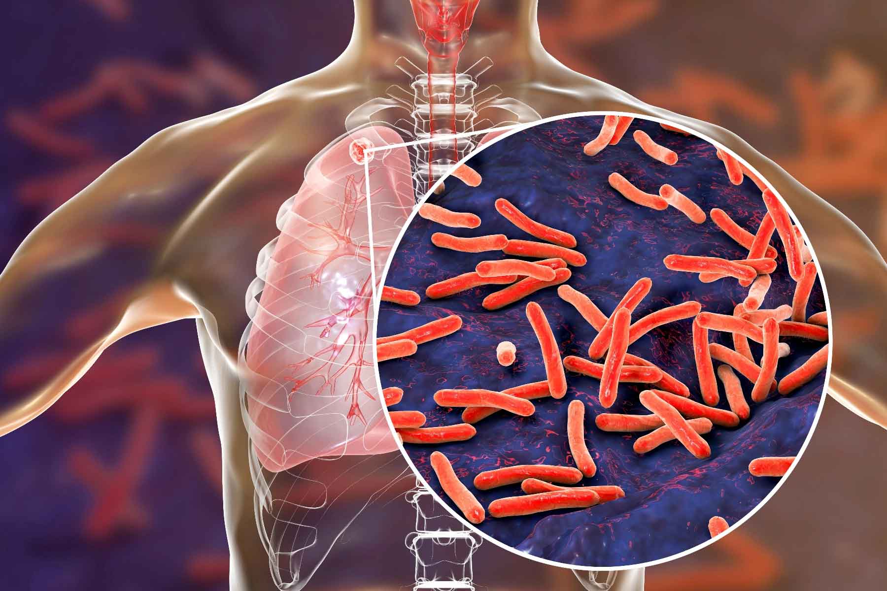 What is tuberculosis?